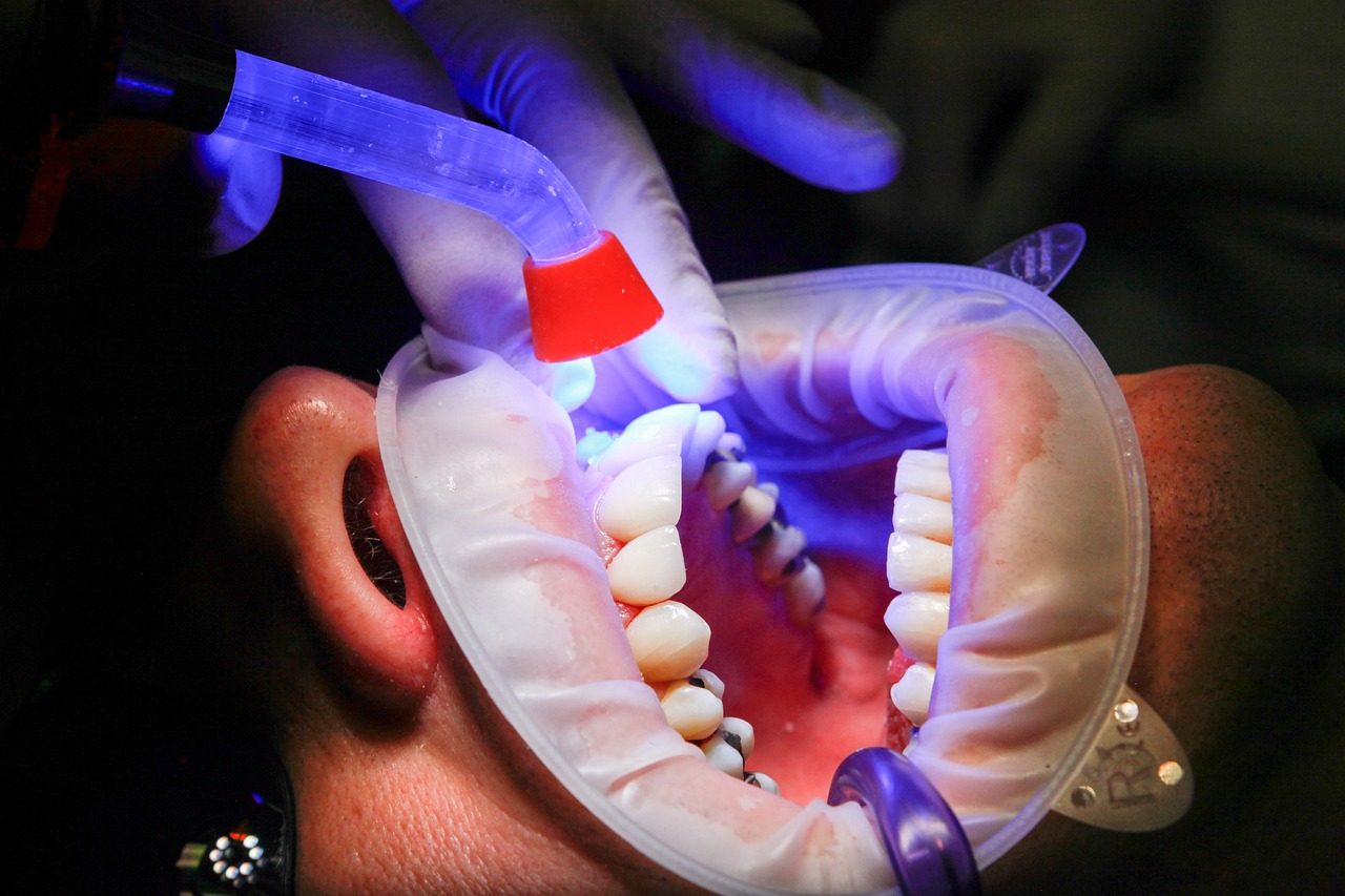 dentist, facet, uv light, curing, teeth, mouth, treatment, uv lamp, patient, clinic, dentist, dentist, dentist, dentist,